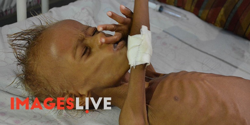 Salim, a five years old child from a village in the province of Al Hudaydah  suffering from extreme malnutrition, receive treatment in one of Al Hudaydah hospital in Yemen