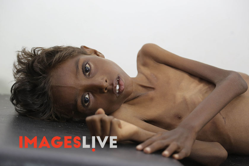 A child suffering from severe malnutrition receive treatment in a hospital in the Hajjah governorate, Yemen