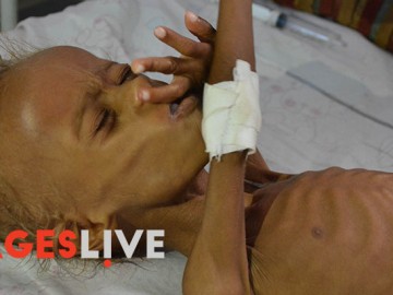 Salim, a five years old child from a village in the province of Al Hudaydah  suffering from extreme malnutrition, receive treatment in one of Al Hudaydah hospital in Yemen